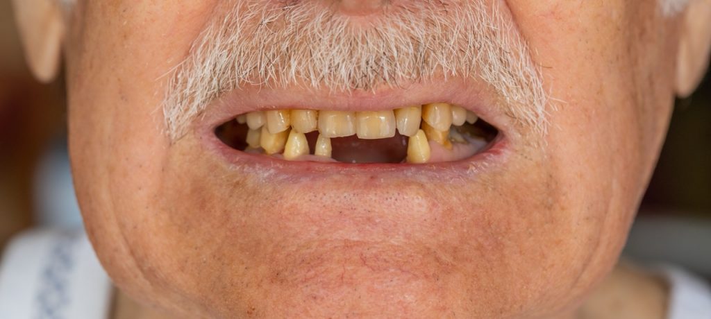 Aging Gracefully with Strong Teeth: Your Essential Guide to Senior Dental Care